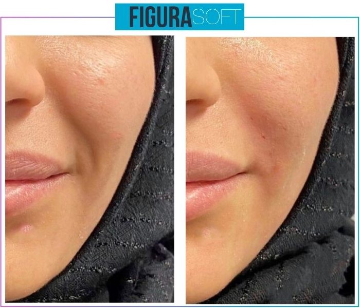 Figura Soft — Nasolabial fold softening