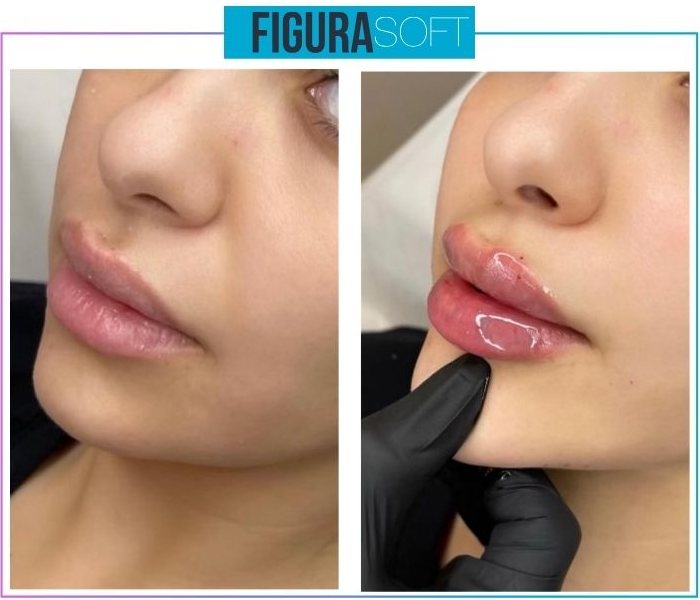 Figura Soft — Lip enhancement
