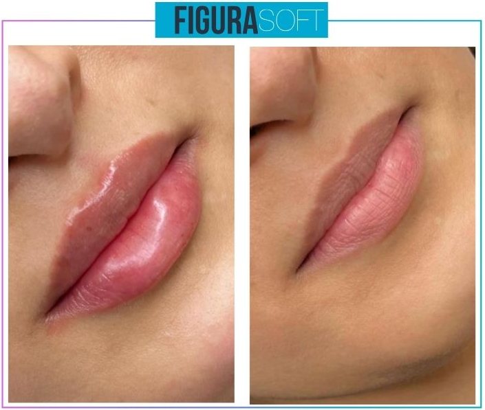 Figura Soft — Lip definition
